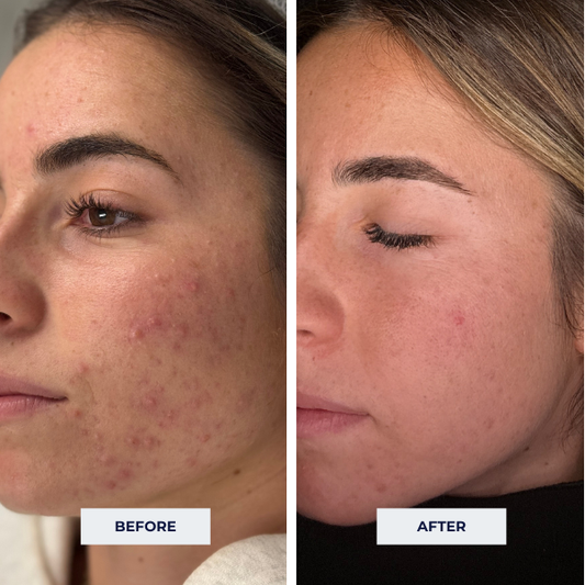 Teen Acne Facial (1 Appointment, No Membership)