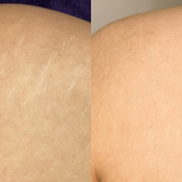 Model Call: Stretch Mark Tattooing