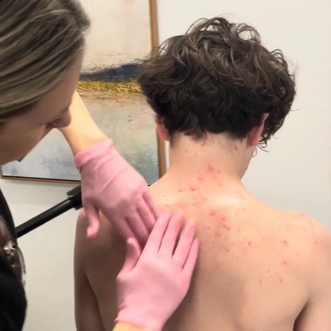 Clear Skin Club Membership (for adult acne)