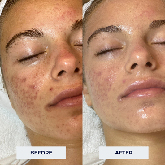 teen clean and clear before after results