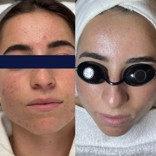 Clear Skin Club Membership (for adult acne)